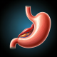 خداحافظی با رفلاکس، سلامتی به روش طبیعی